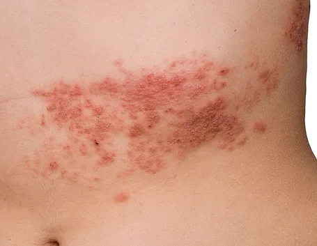 Eruzione cutanea