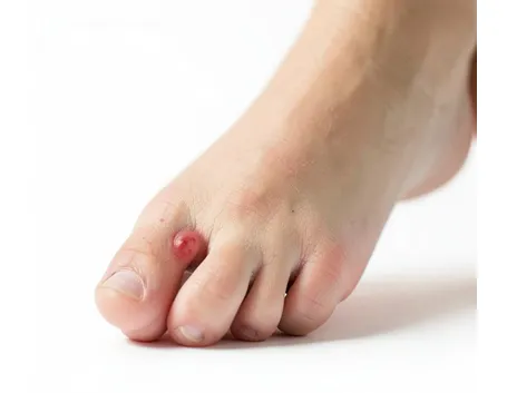 Esempio di cisti tendinea