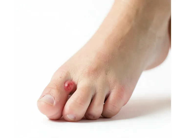 Esempio di cisti tendinea