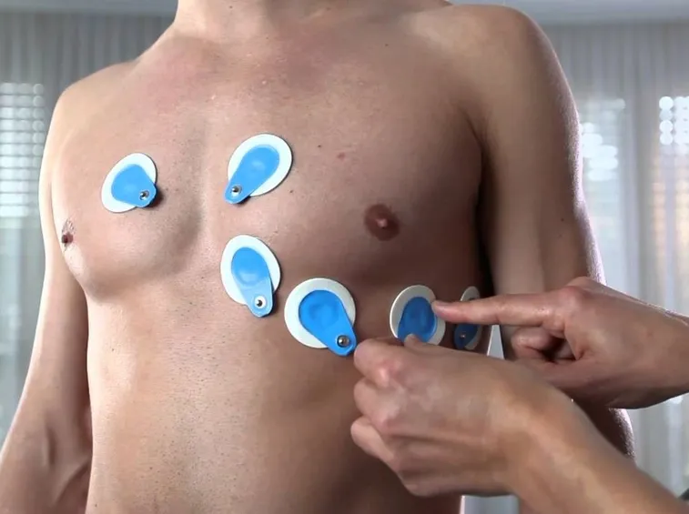 Posizionamento elettrodi ECG