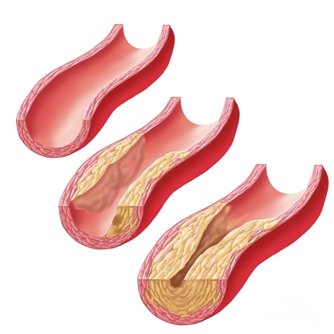 placca aterosclerotica in accrescimento